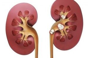 kidney stones as a contraindication to a protein diet